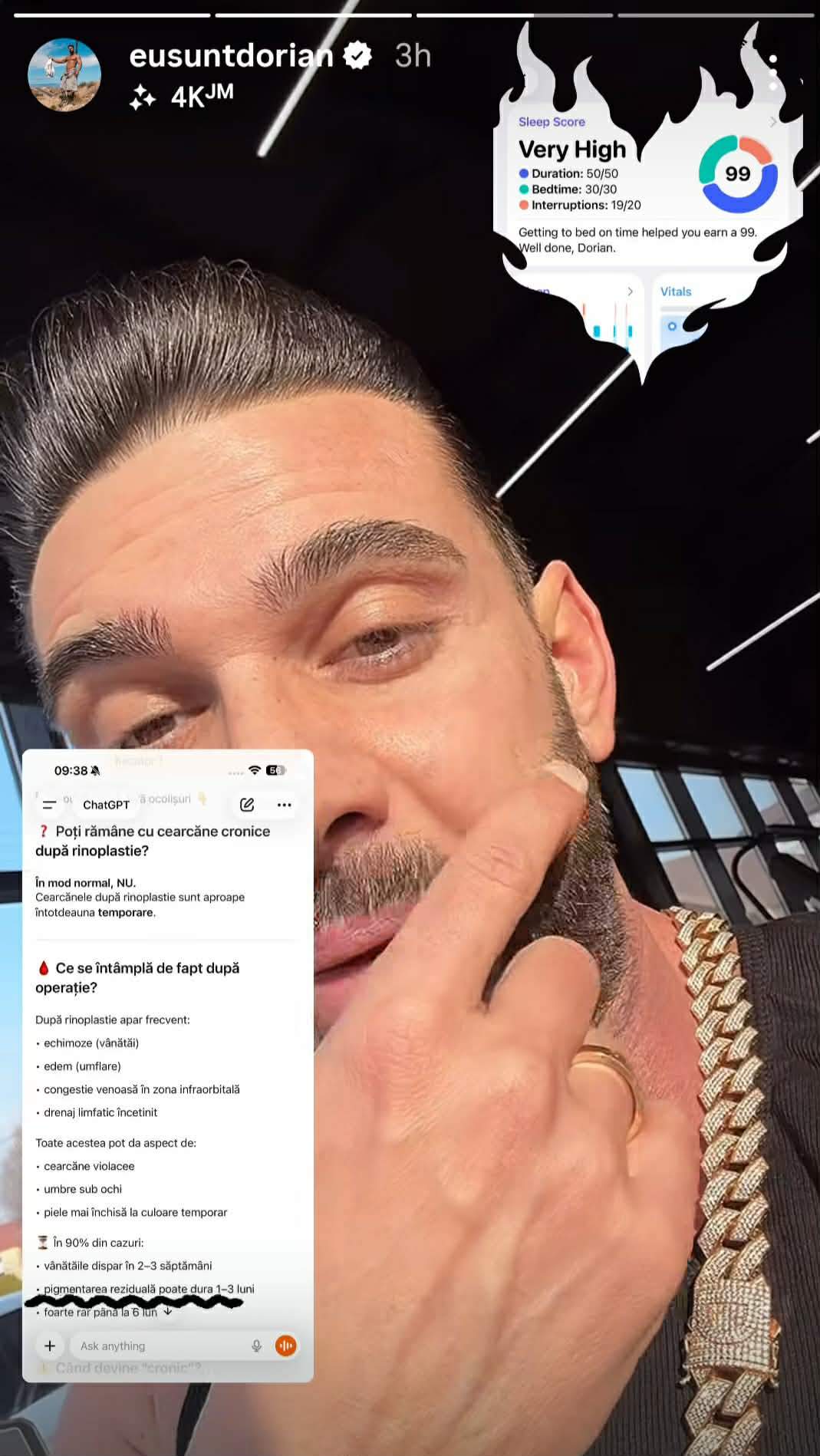 Cum se simte Dorian Popa după operația suferită la nas. „Dacă sunteți în context, nu vă speriați”