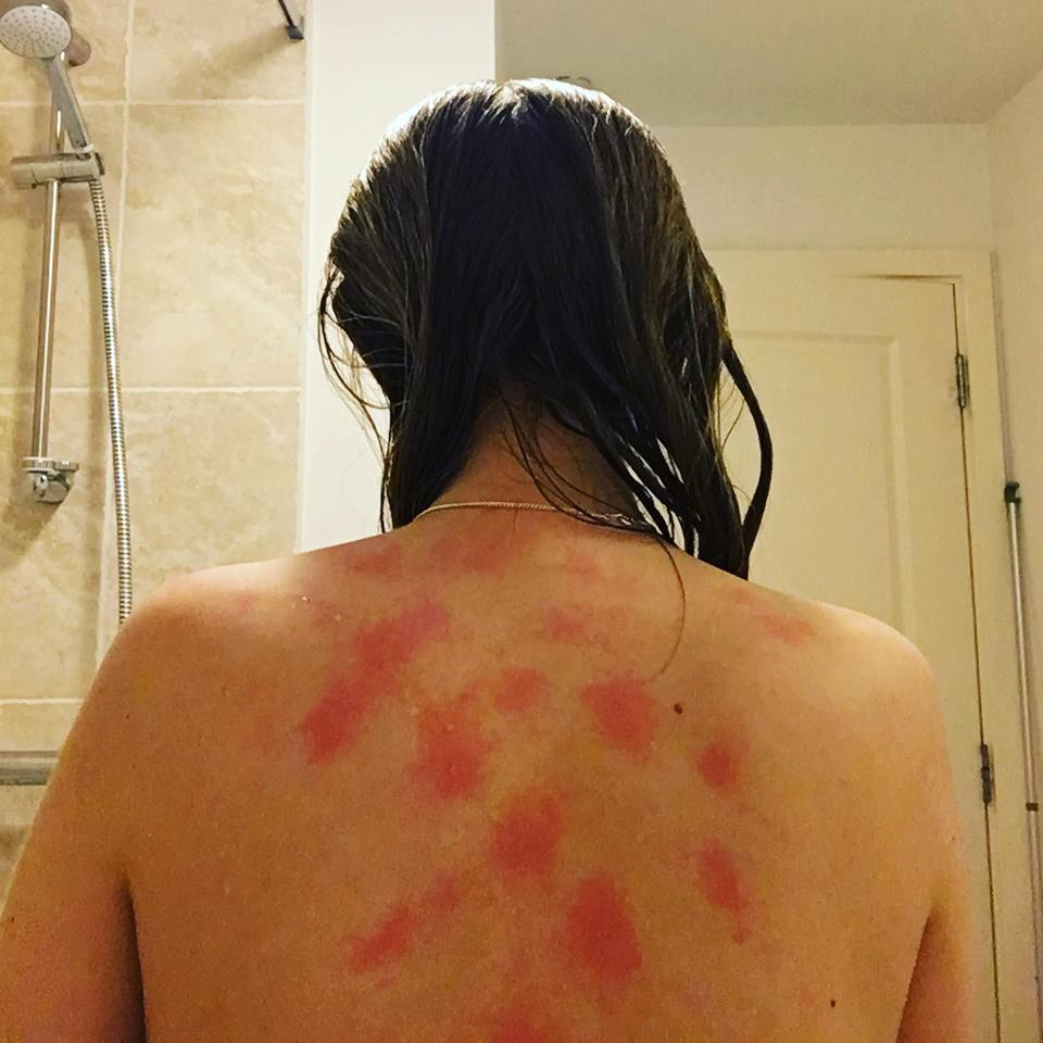 O britanică este alergică la propriile lacrimi. Pentru ea, orice contact cu apa este un coșmar (FOTO)