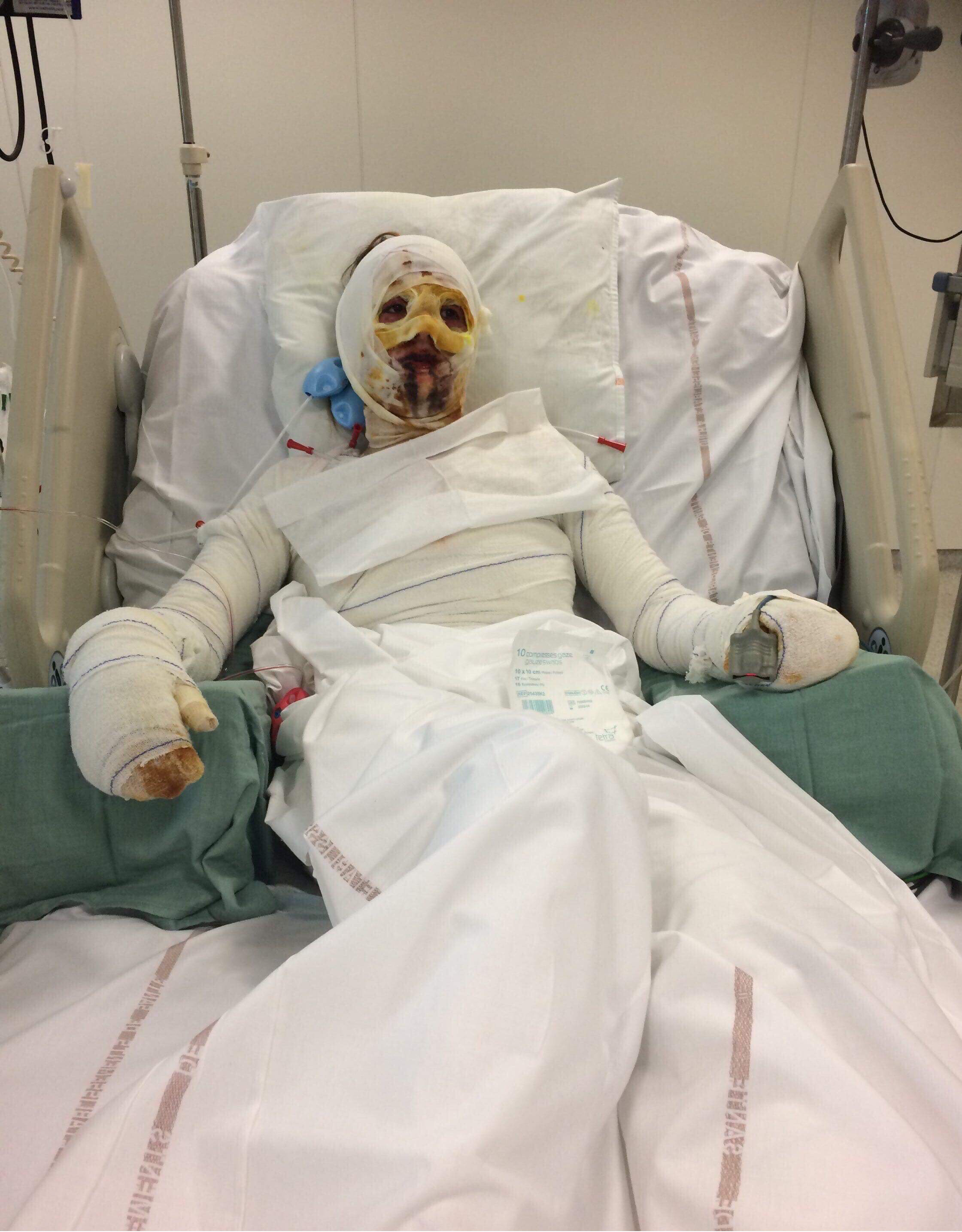 Fotografii cu puternic impact emoțional! Un medicament banal pentru amigdalită a desfigurat-o și i-a provocat arsuri groaznice pe 90 la sută din piele! Mărturiile cutremurătoare ale victimei
