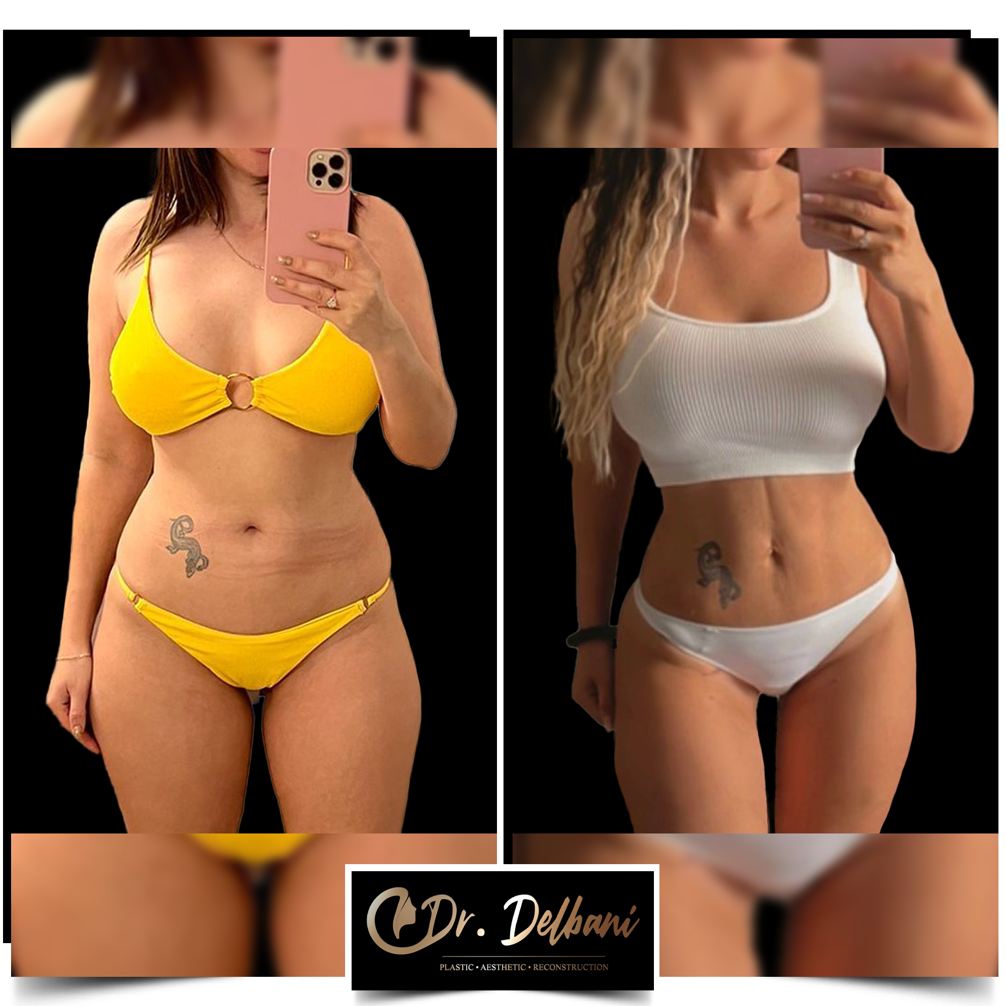 Cum să obții un abdomen ca în sala de sport. Transformarea corpului cu ajutorul liposucției abdominale Vaser HD by Dr. Delbani