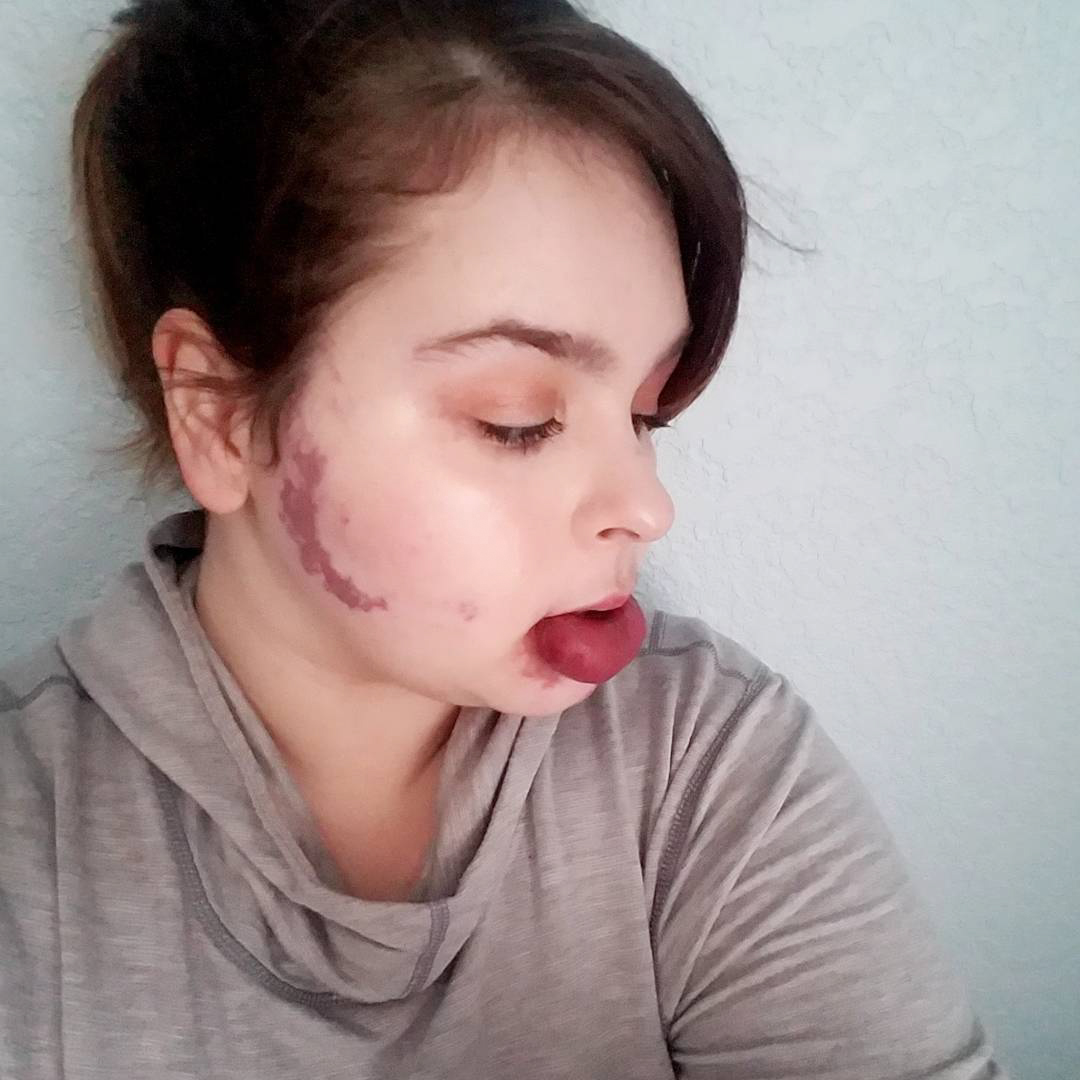 FOTO | Povestea femeii care a fost întrebată toată viața dacă a fost lovită peste față din cauza semnului din naștere de pe buze