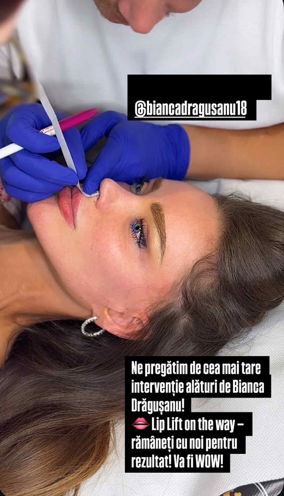 Bianca Drăgușanu și-a făcut o nouă operație estetică la față. Cât costă procedura chirurgicală care e gata în 30 de minute: „Va fi wow”