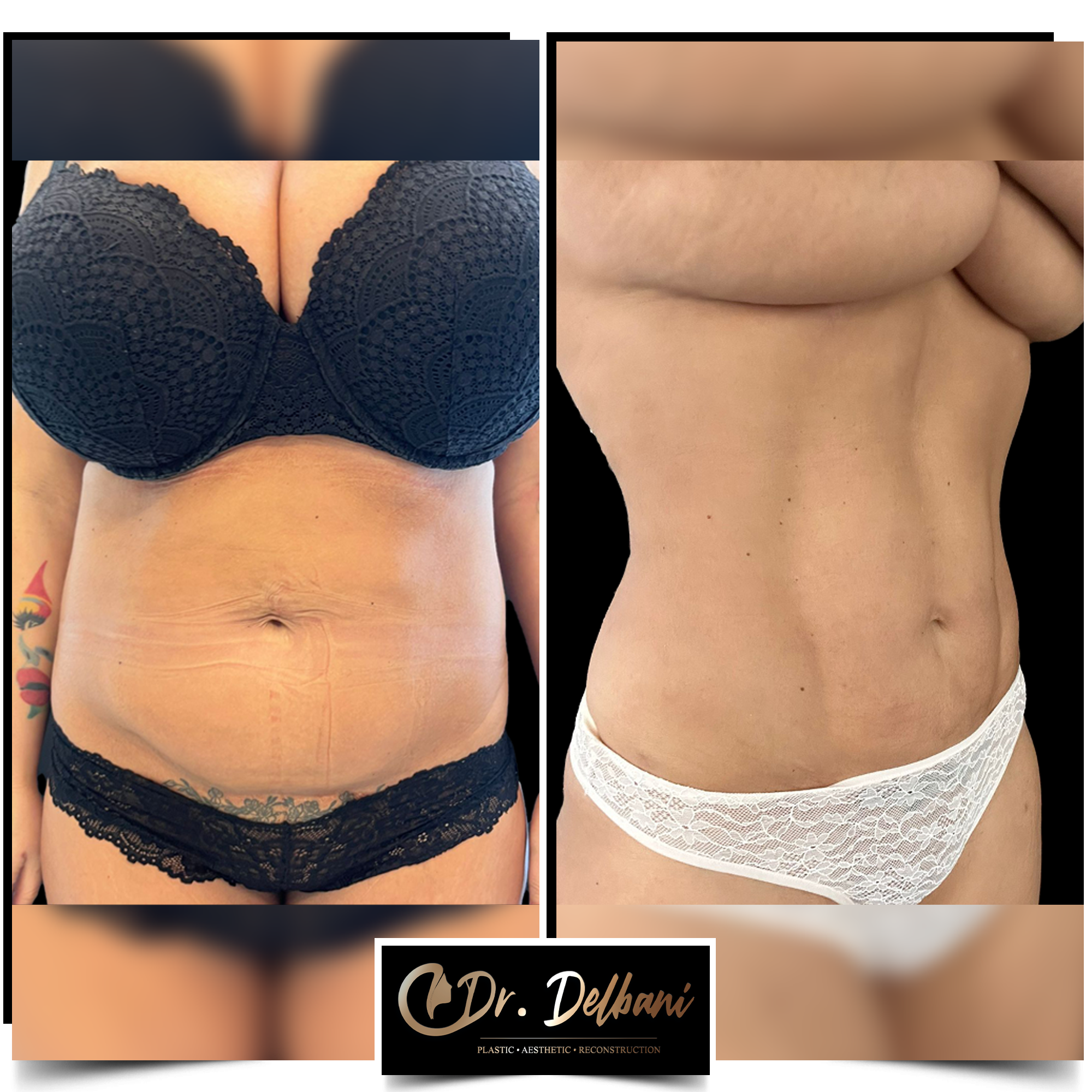 Cum să obții un abdomen ca în sala de sport. Transformarea corpului cu ajutorul liposucției abdominale Vaser HD by Dr. Delbani