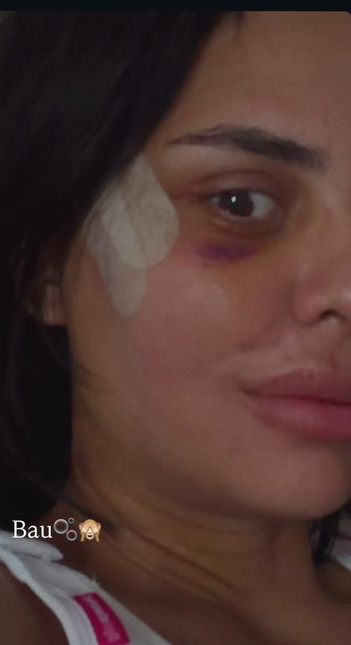 Cum arată Andreea Popescu la 7 zile de la operațiile estetice: „Sunt extrem de umflată, am capul cât o minge, sunt vânătă”