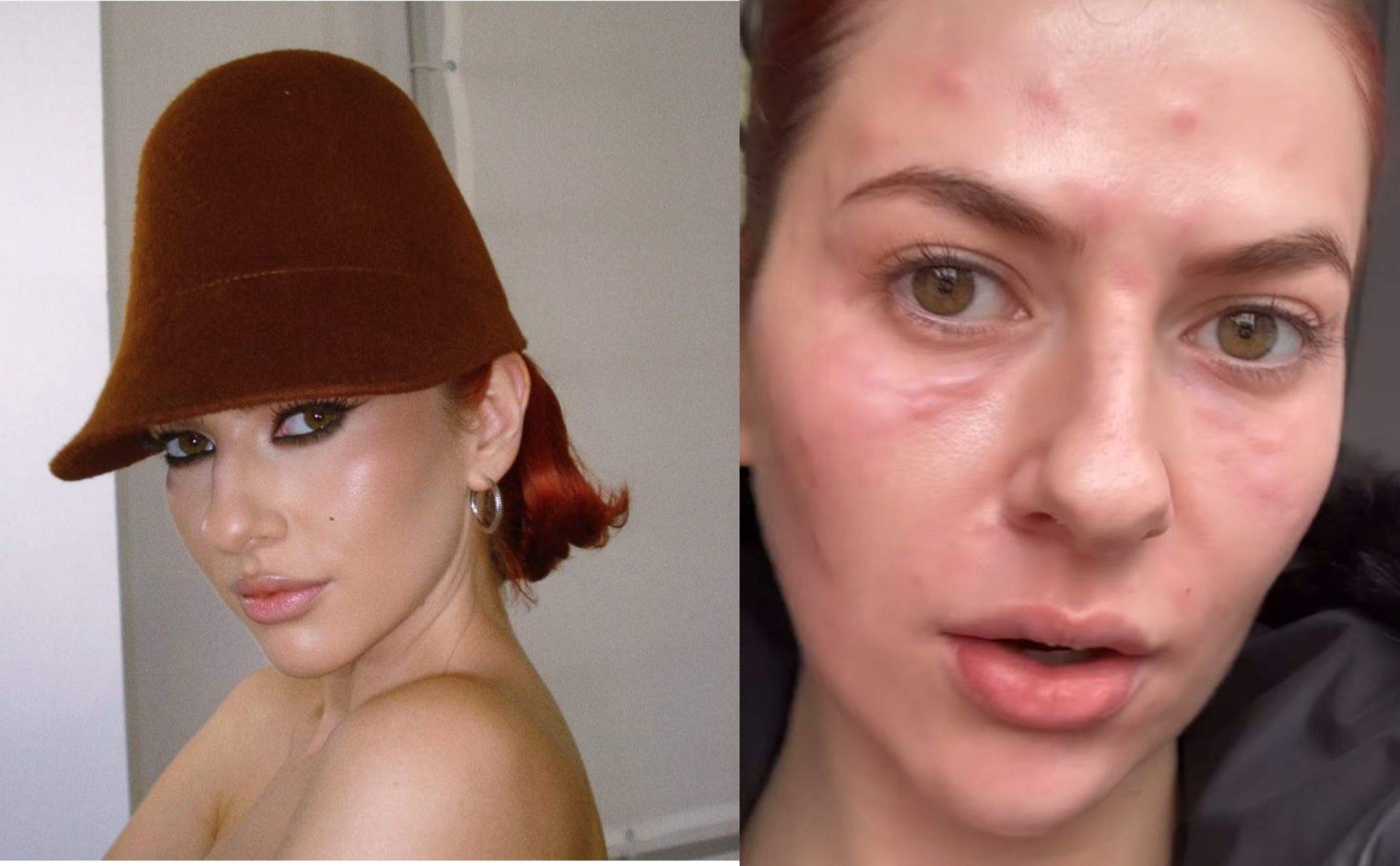 Cum arată Lidia Buble nemachiată. Artista a apărut cu fața inflamată și le-a transmis fanilor un mesaj. „Zici că mă transform într-o reptilă”