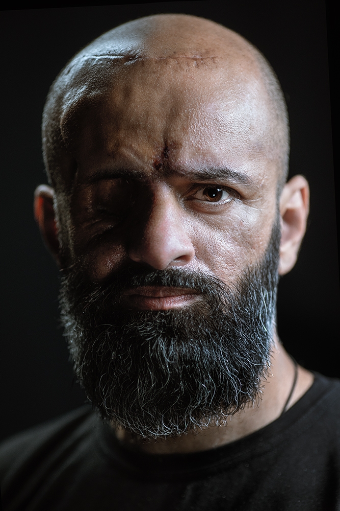 Soldat ucrainean care și-a pierdut ochiul drept pe front: „Cel mai rău este când îmi vine să plâng, dar nu mai pot”
