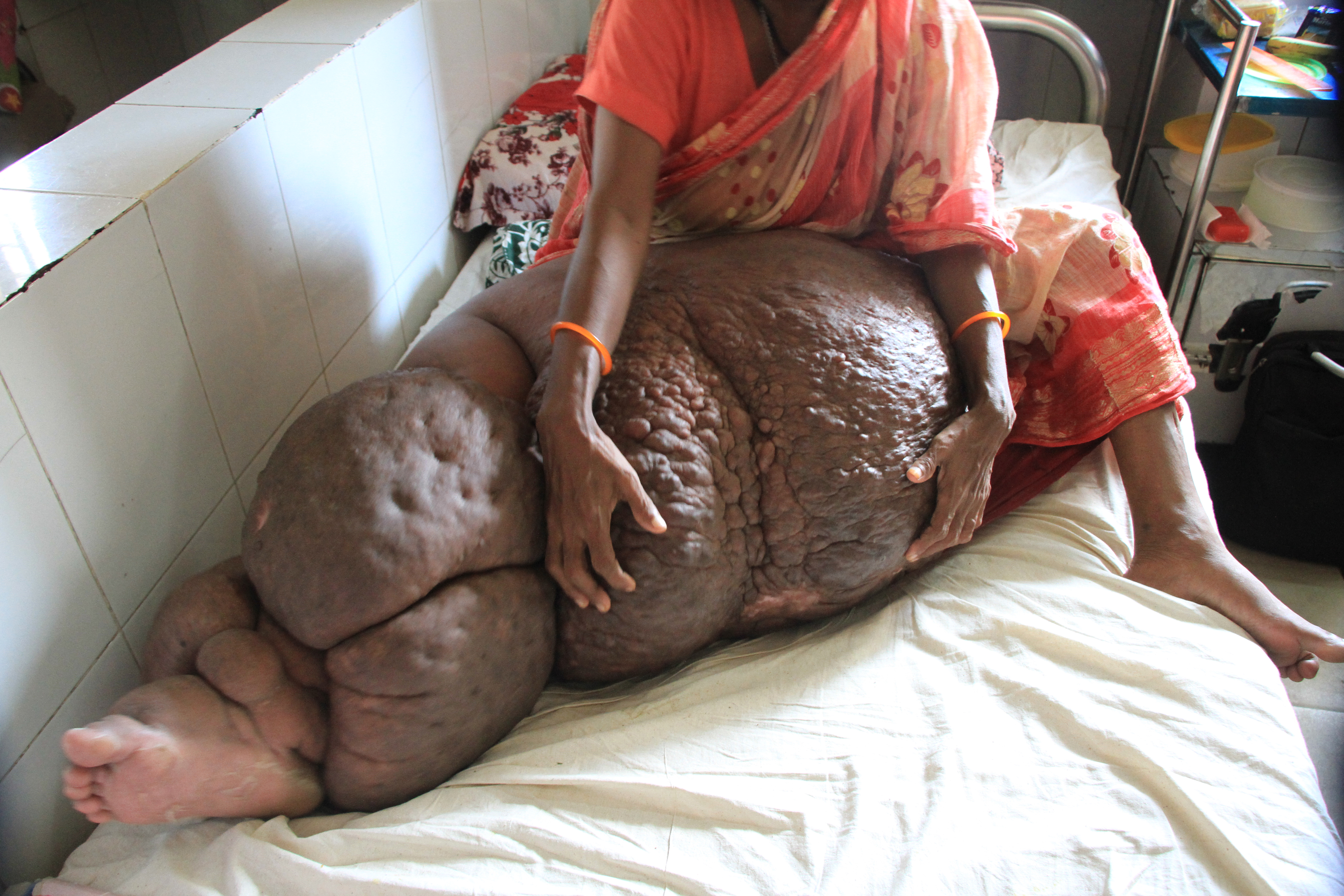 FOTO | Drama unei femei bolnave de elefantiazis. Piciorul ei a ajuns să cântărească 60 de kilograme
