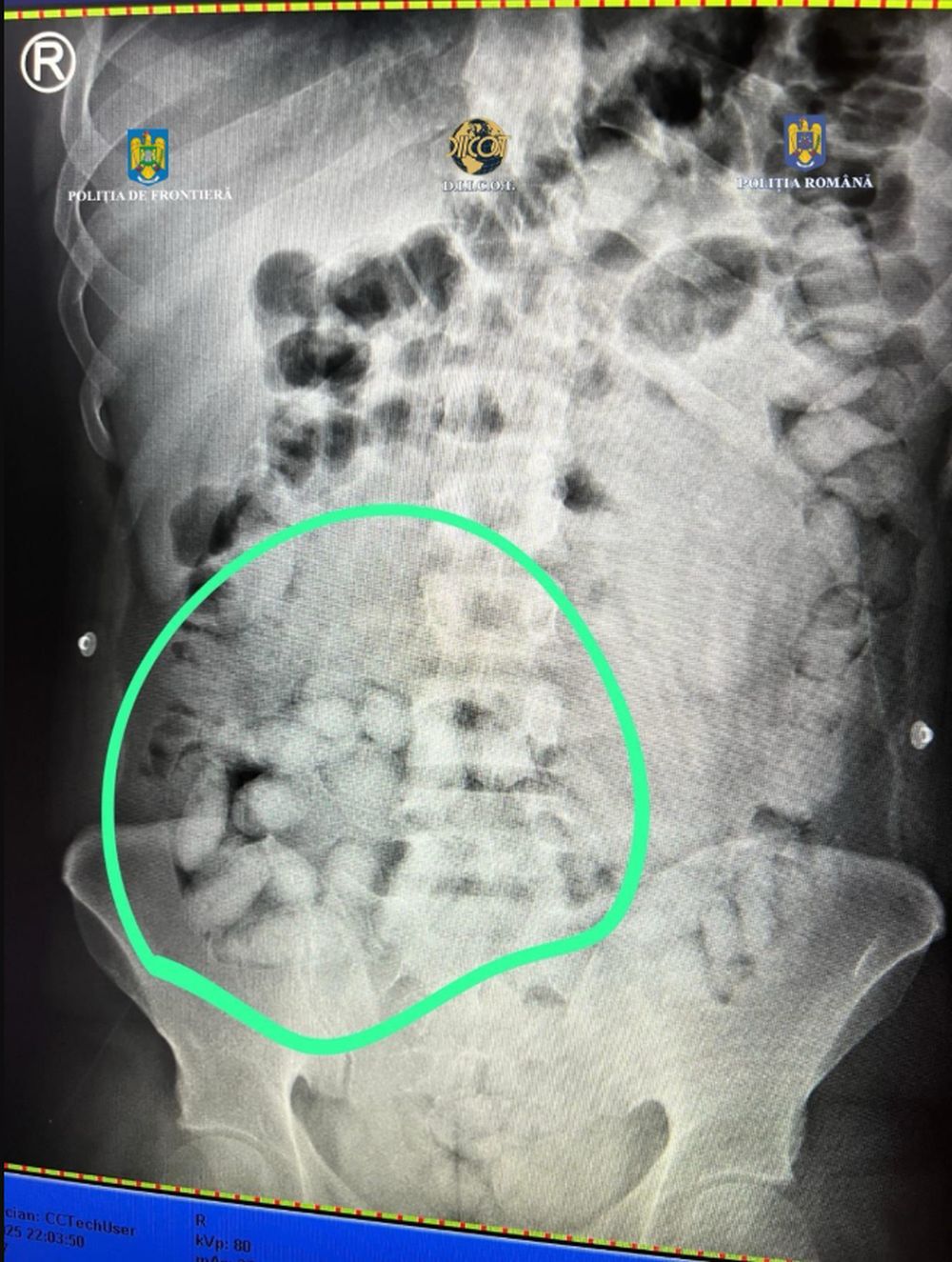 Un brazilian care înghițise capsule cu cocaină și avea altele lipite pe picioare, prins pe Aeroportul Otopeni din București - Foto