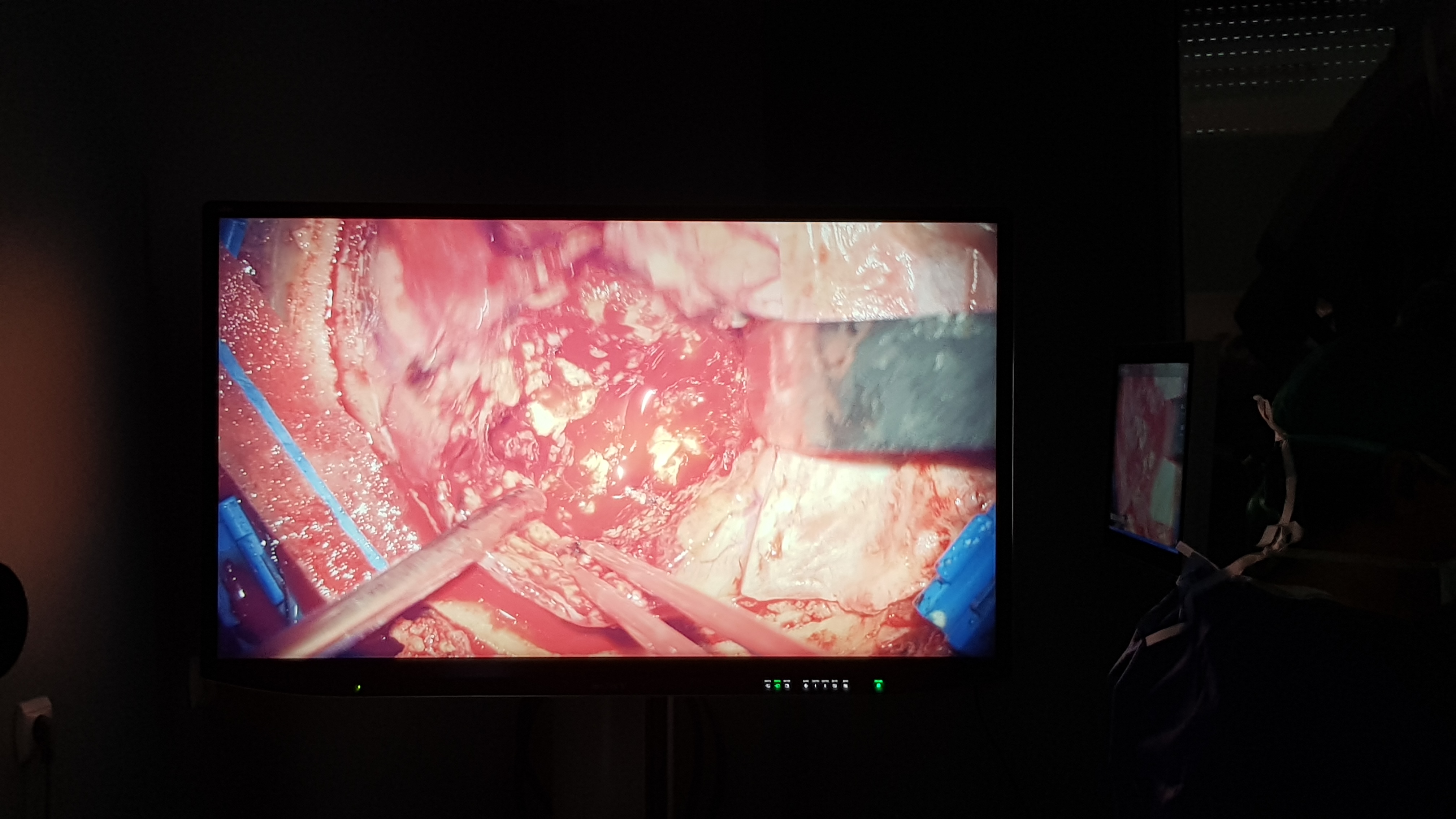 VIDEO&FOTO/ Operație pe creier cu aparatură de 1 milion de euro la Spitalul de Neurochirurgie din Iași. Medicul Lucian Eva: "Cu această aparatură intervenția devine minim invazivă"