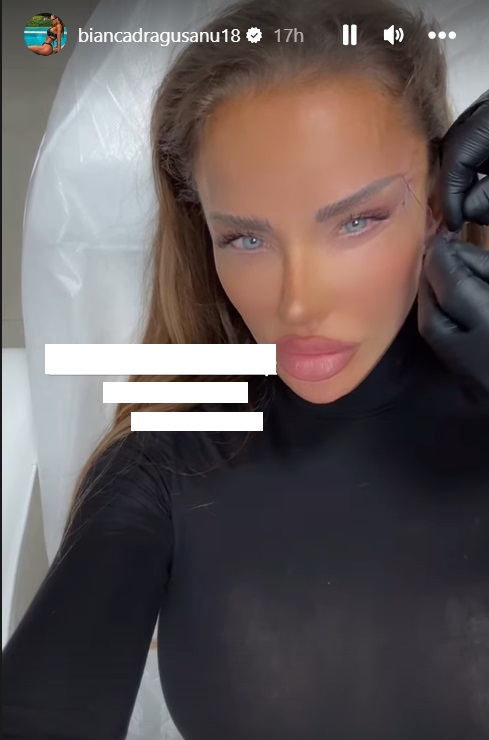 Cum arată Bianca Drăgușanu după cea mai nouă intervenție estetică la față. Ce presupune procedura „cat eye”