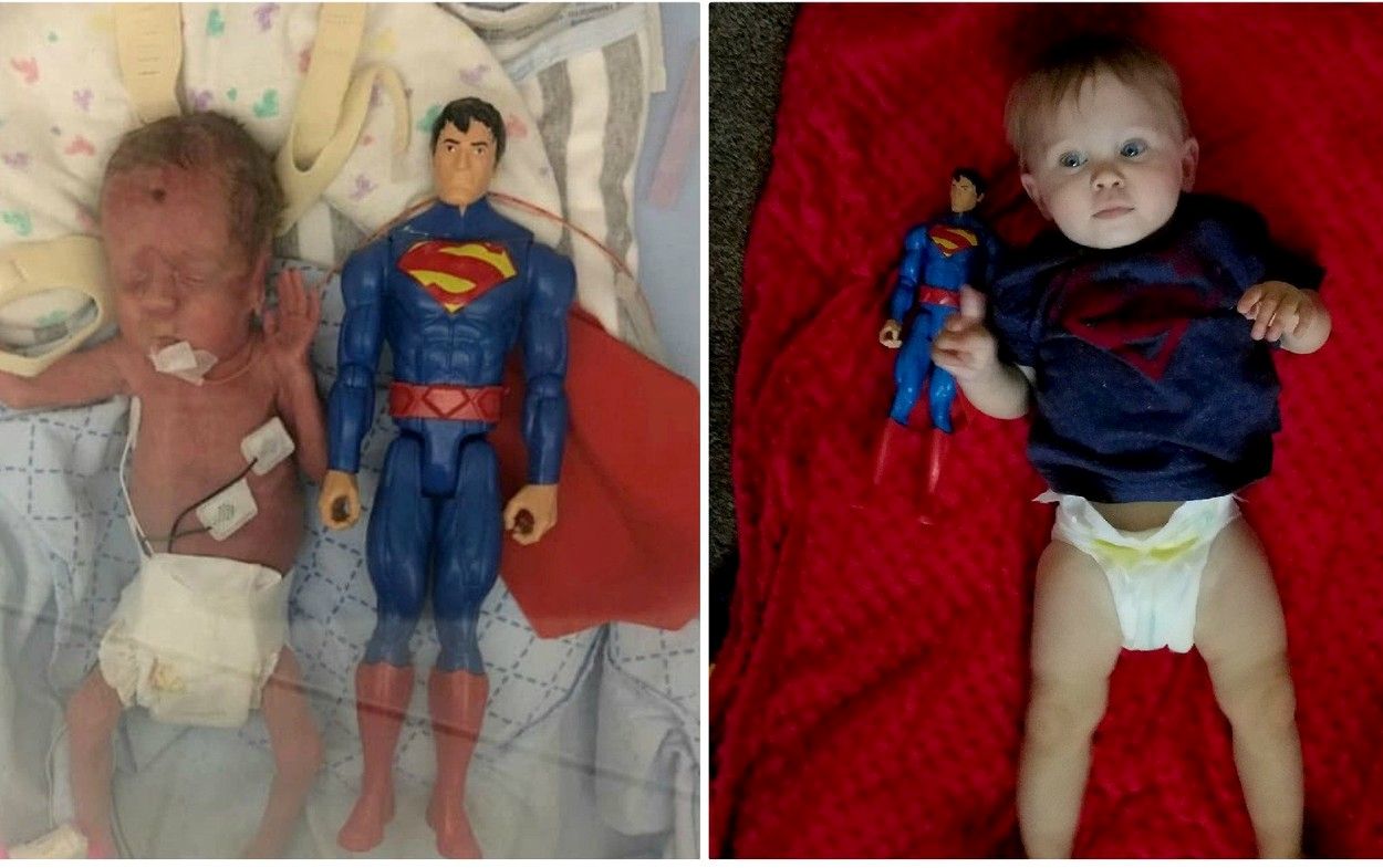 Povestea băieţelului care la naştere era cât o figurină Superman. Medicii nu i-au dat șanse de supraviețuire