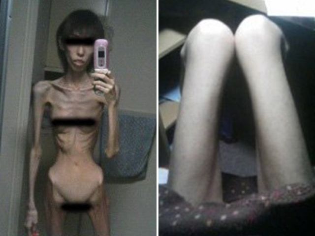 FOTOGRAFII ȘOCANTE | O tânără fost înfometată de bunicul ei până la anorexie