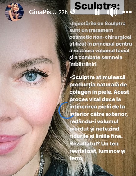 Cum arată Gina Pistol la 43 de ani, după ce și-a făcut un nou tratament estetic la față: „Mi-a pus în frunte botox, mi-a băgat și în bărbie”
