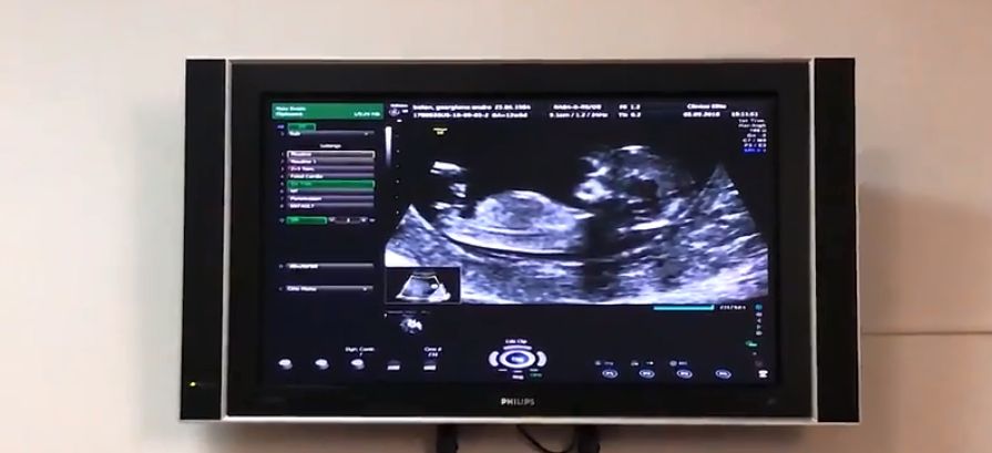 Andreea Bălan a arătat ecografia bebelușului. "Să vedem ce sex are" | FOTO