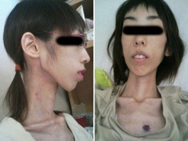 FOTOGRAFII ȘOCANTE | O tânără fost înfometată de bunicul ei până la anorexie