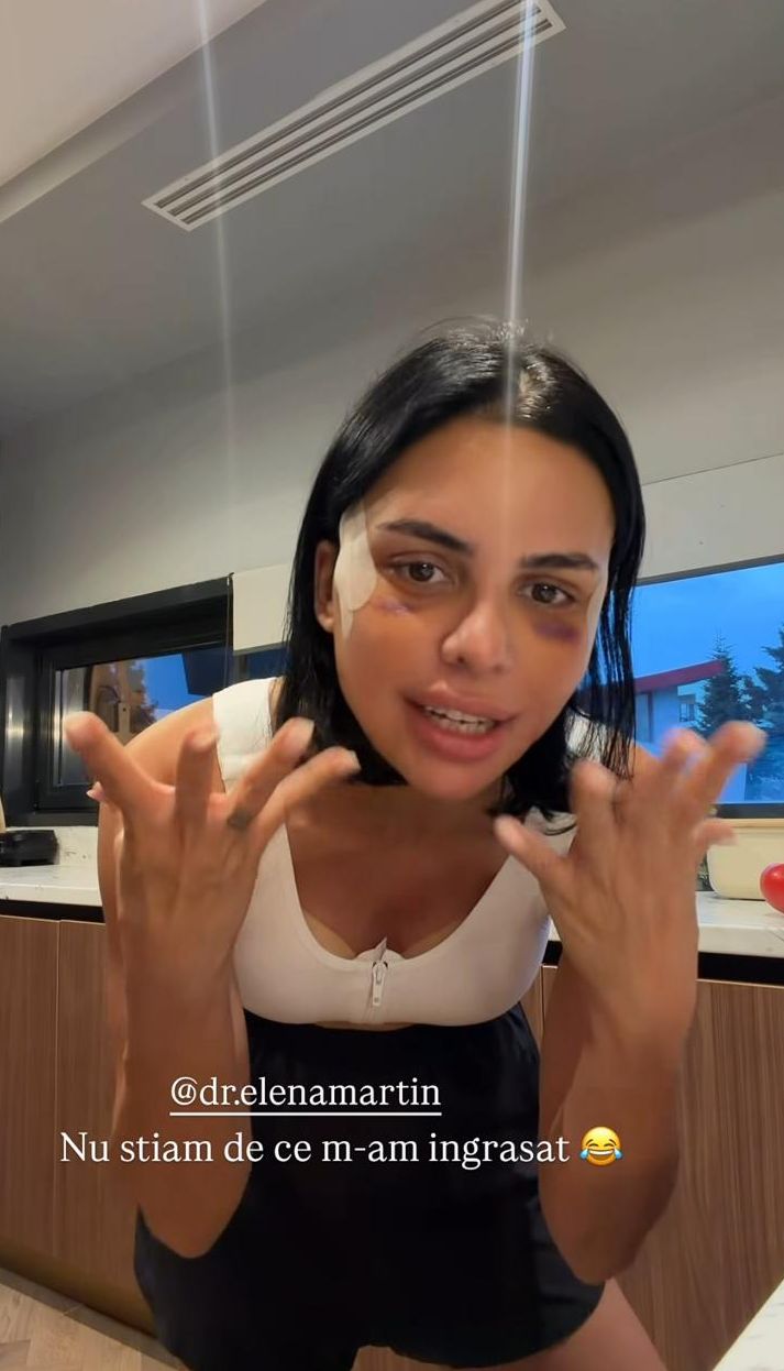 Cum arată Andreea Popescu la 7 zile de la operațiile estetice: „Sunt extrem de umflată, am capul cât o minge, sunt vânătă”