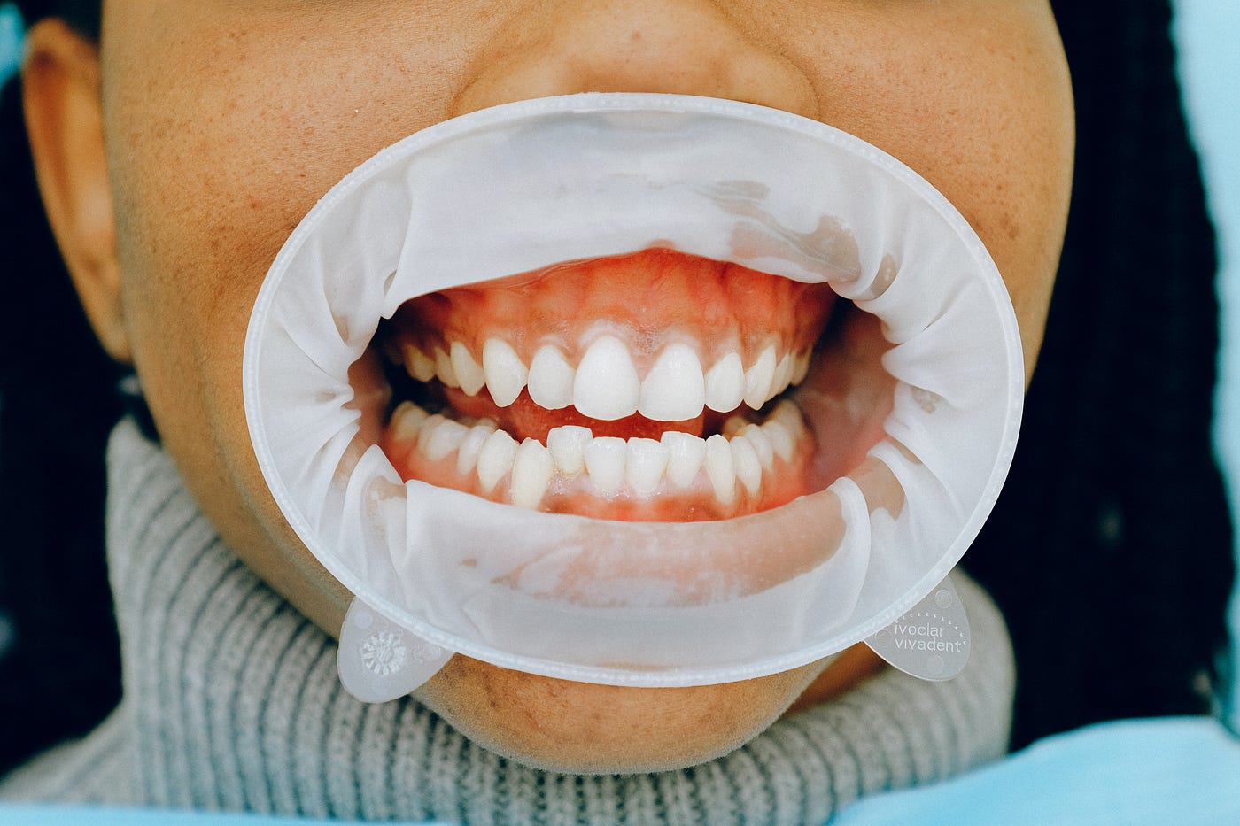 Crowded or crooked teeth will need braces [Medium]