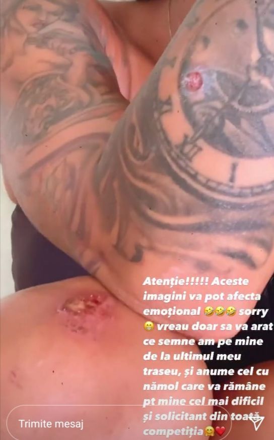 Ana Porgras, grav accidentată după ultimul joc de la „Survivor România”. Și-a arătat rănile