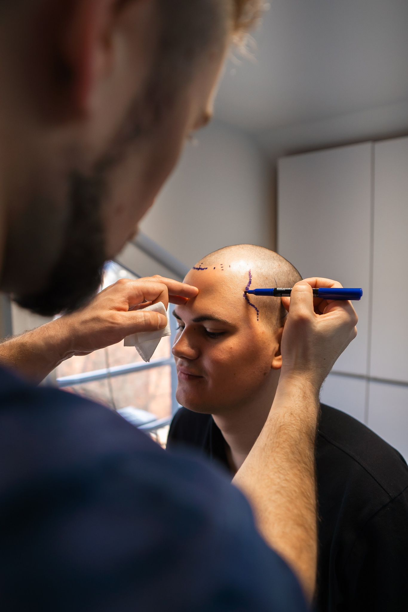 David, fiul cel mare al Ancăi Serea, și-a făcut transplant de păr la Cluj. Imagini din cabinetul medicului