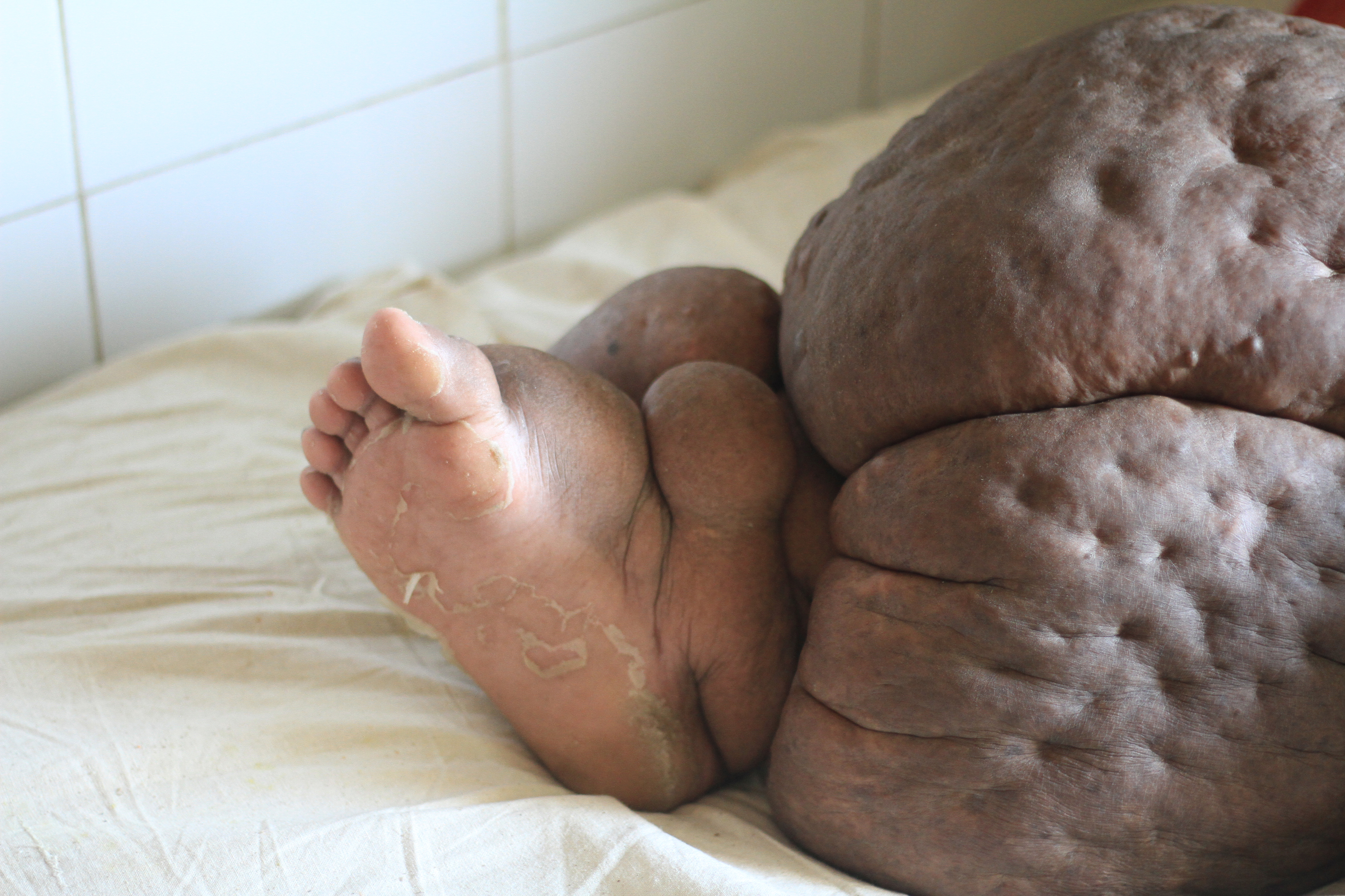 FOTO | Drama unei femei bolnave de elefantiazis. Piciorul ei a ajuns să cântărească 60 de kilograme
