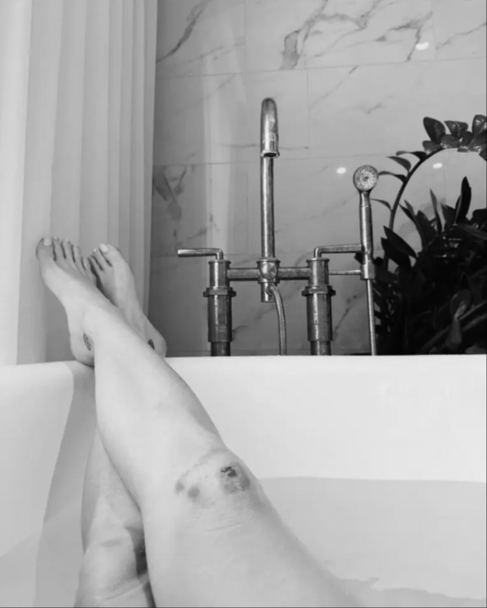 Katy Perry și-a arătat rănile suferite în timpul turneului său „Lifetimes”. După ce a fost aproape să cadă de la înălțime, acum are altă suferință