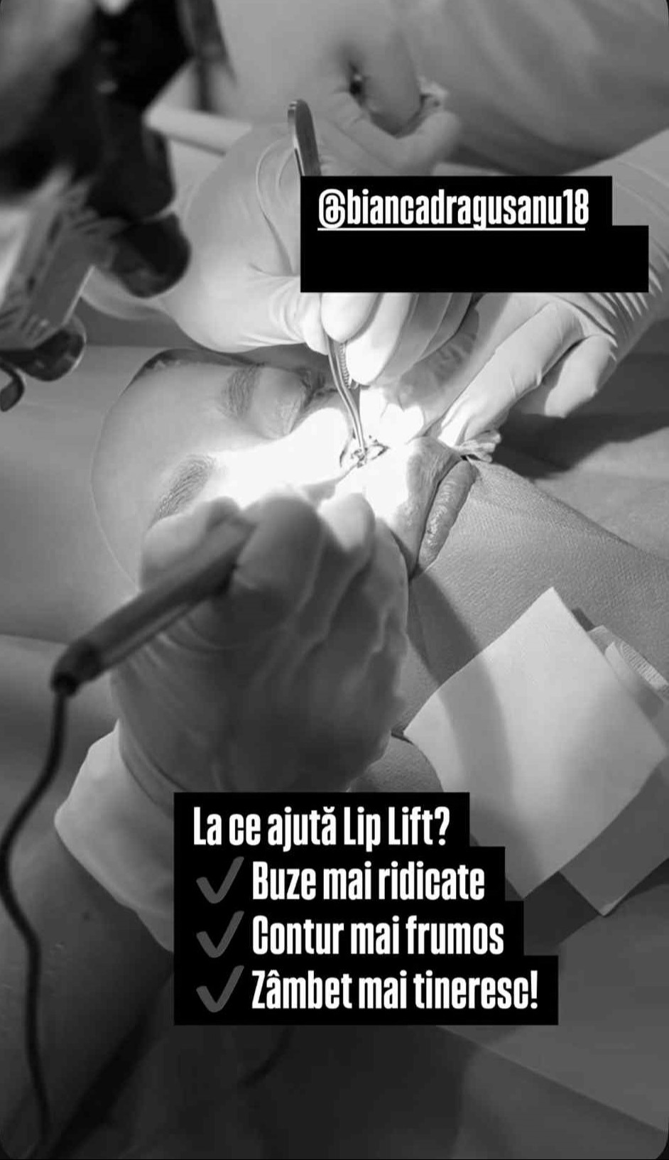 Bianca Drăgușanu și-a făcut o nouă operație estetică la față. Cât costă procedura chirurgicală care e gata în 30 de minute: „Va fi wow”