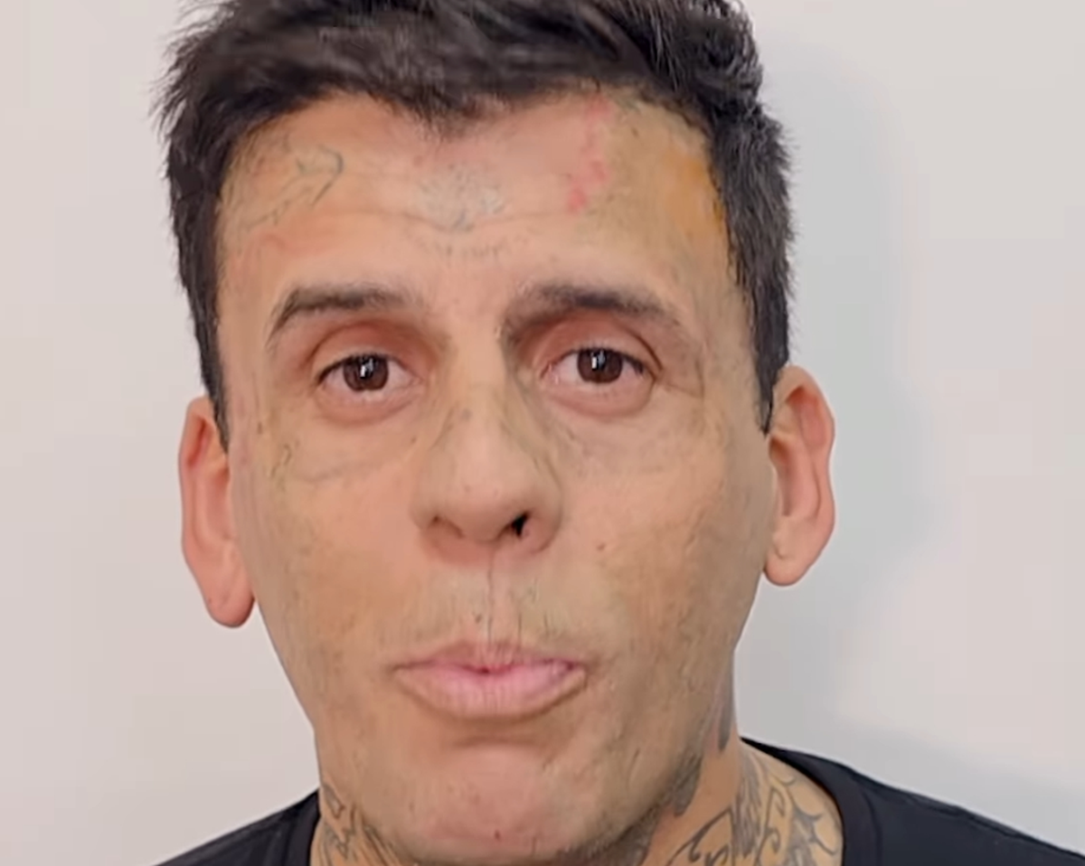 Dependentul de tatuaje care și-a pictat 95% din corp arată de nerecunoscut, după ce și le-a scos printr-o procedură dureroasă