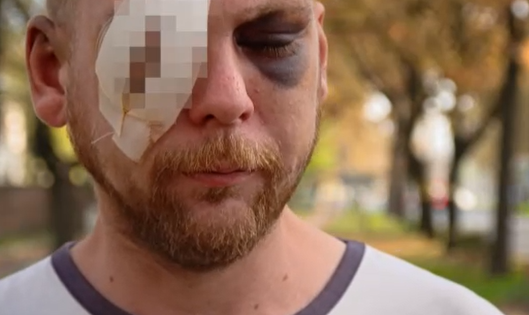 „Cserben hagytak ott vérbe fagyva” – Debrecen utcáin fényes nappal úgy megvertek egy férfit, hogy fél szemére megvakult