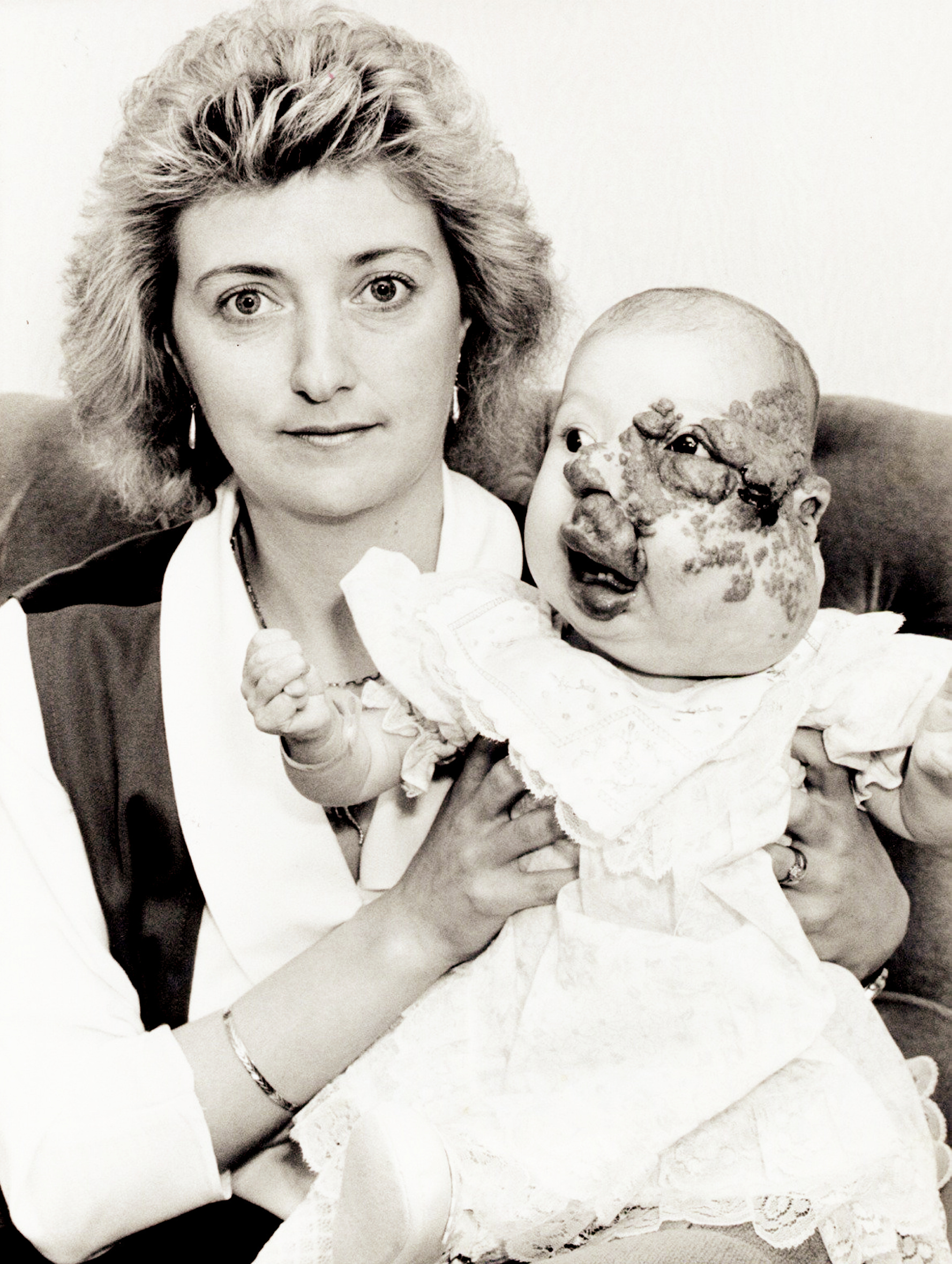 Povestea femeii care s-a născut cu o deformare facială severă și a trecut prin 18 operații extreme. După 14 ani de suferință, este în sfârșit fericită | FOTO