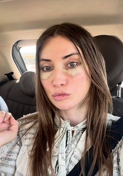 Iulia Albu, sinceră despre intervențiile estetice: „Mi-am dorit un deep plane facelift. Fără filtre, fără vrăjeală”