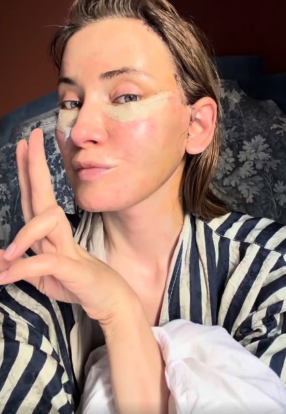 Iulia Albu, sinceră despre intervențiile estetice: „Mi-am dorit un deep plane facelift. Fără filtre, fără vrăjeală”