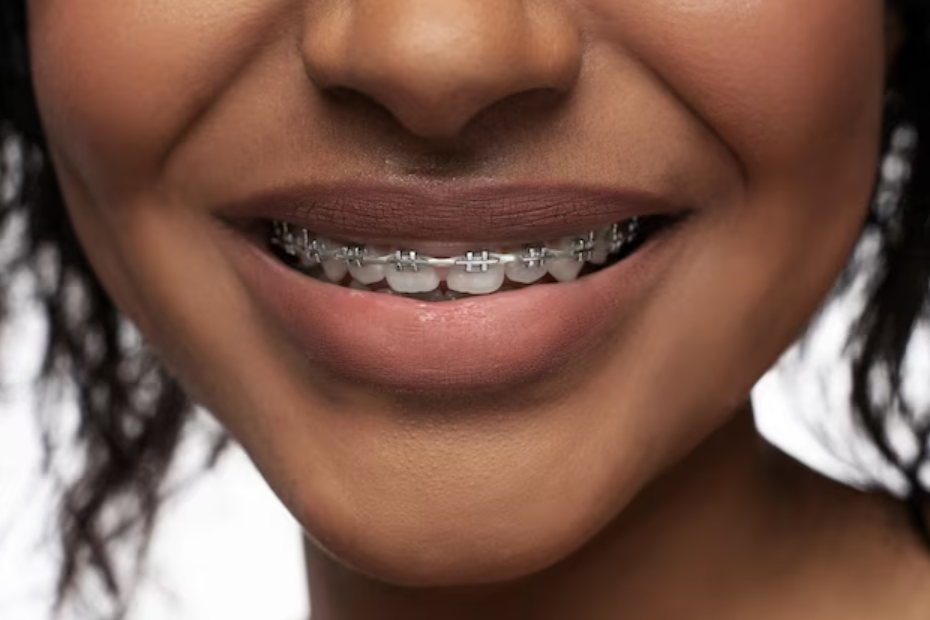 5 signs you may need to get braces