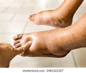 What causes a pregnant woman’s feet to swell?