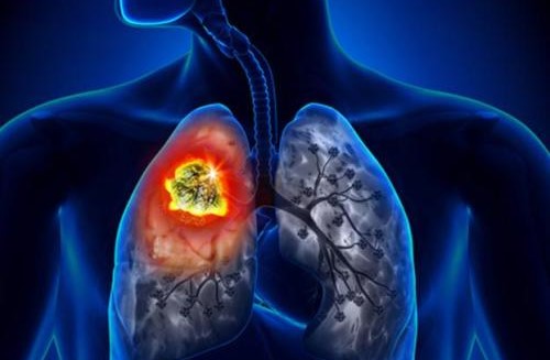 Már a kilégzésből is ki tudják mutatni a tüdőrákot