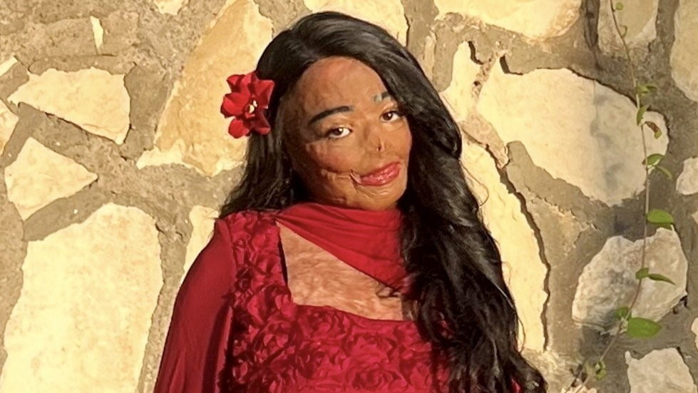 Lángra kapott a sampon a haján, harmadfokú égési sérüléseket szerzett egy nő Angliában – fotók