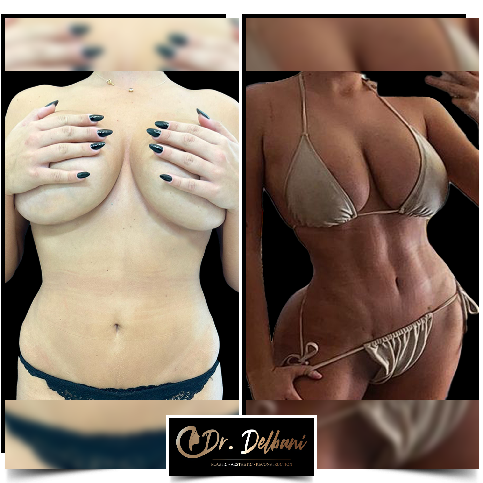 Cum să obții un abdomen ca în sala de sport. Transformarea corpului cu ajutorul liposucției abdominale Vaser HD by Dr. Delbani