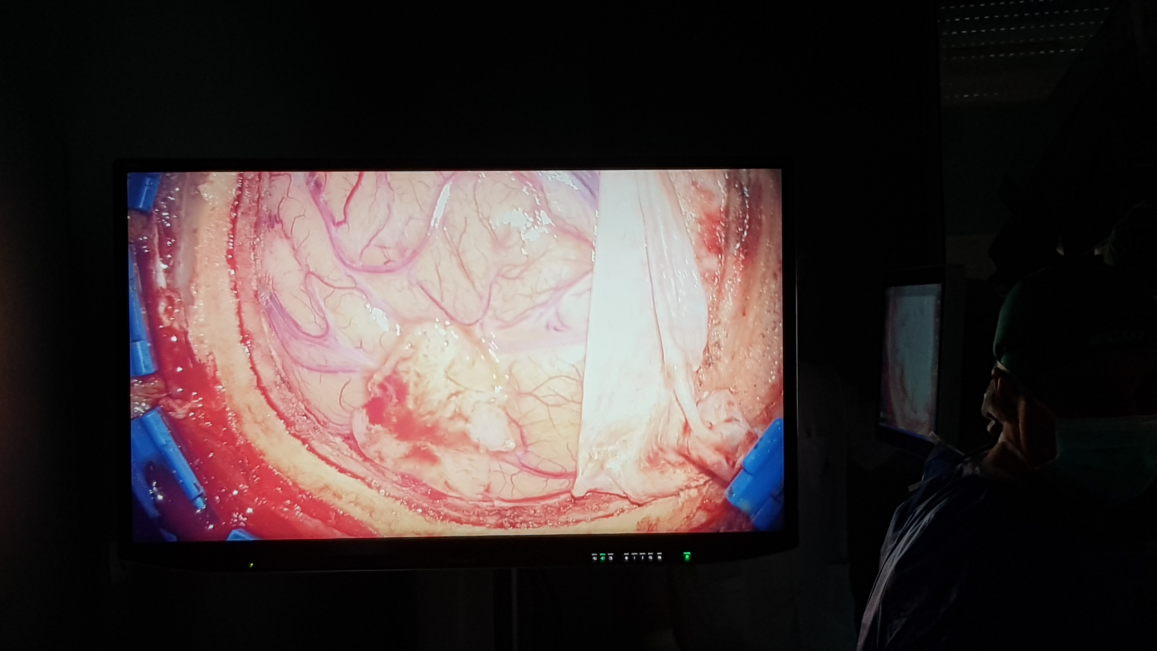 VIDEO&FOTO/ Operație pe creier cu aparatură de 1 milion de euro la Spitalul de Neurochirurgie din Iași. Medicul Lucian Eva: "Cu această aparatură intervenția devine minim invazivă"