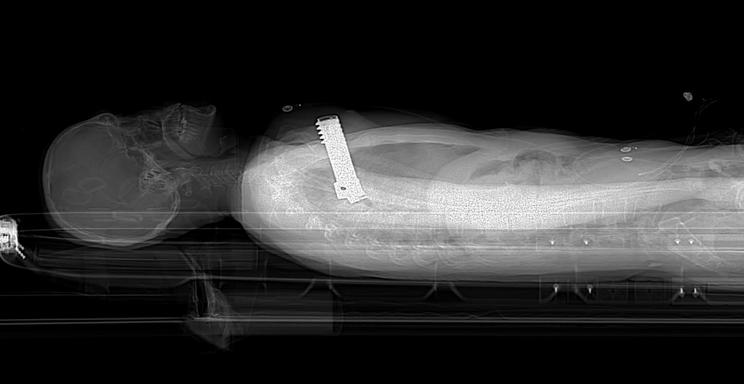 „Csoda, hogy még mindig élek” - Elítélték a lövészetvezetőt, aki miatt László kezében felrobbant a puska