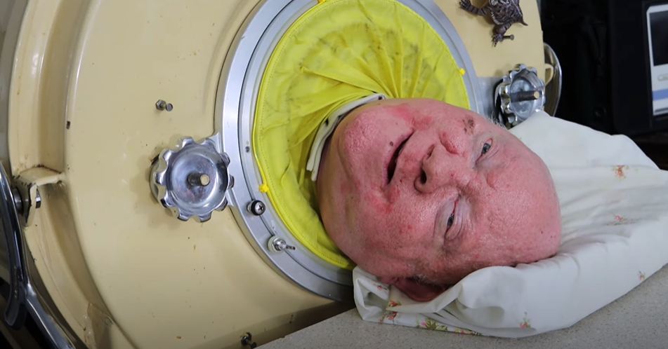 Meghalt Paul Alexander, a férfi, aki több mint 70 évet élt vastüdőben