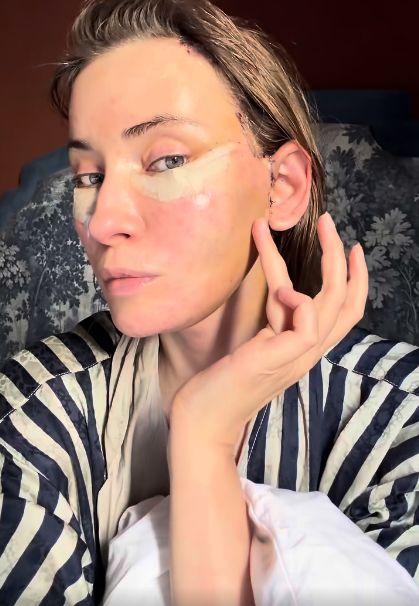 Iulia Albu, sinceră despre intervențiile estetice: „Mi-am dorit un deep plane facelift. Fără filtre, fără vrăjeală”
