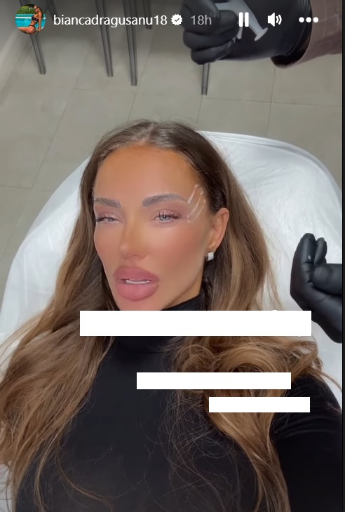 Cum arată Bianca Drăgușanu după cea mai nouă intervenție estetică la față. Ce presupune procedura „cat eye”