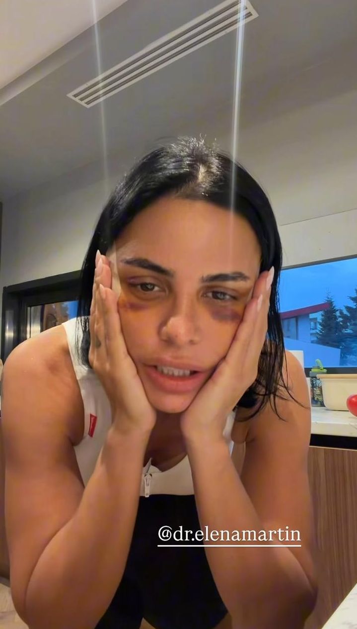 Cum arată Andreea Popescu la 7 zile de la operațiile estetice: „Sunt extrem de umflată, am capul cât o minge, sunt vânătă”