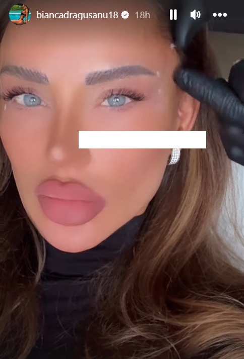 Cum arată Bianca Drăgușanu după cea mai nouă intervenție estetică la față. Ce presupune procedura „cat eye”
