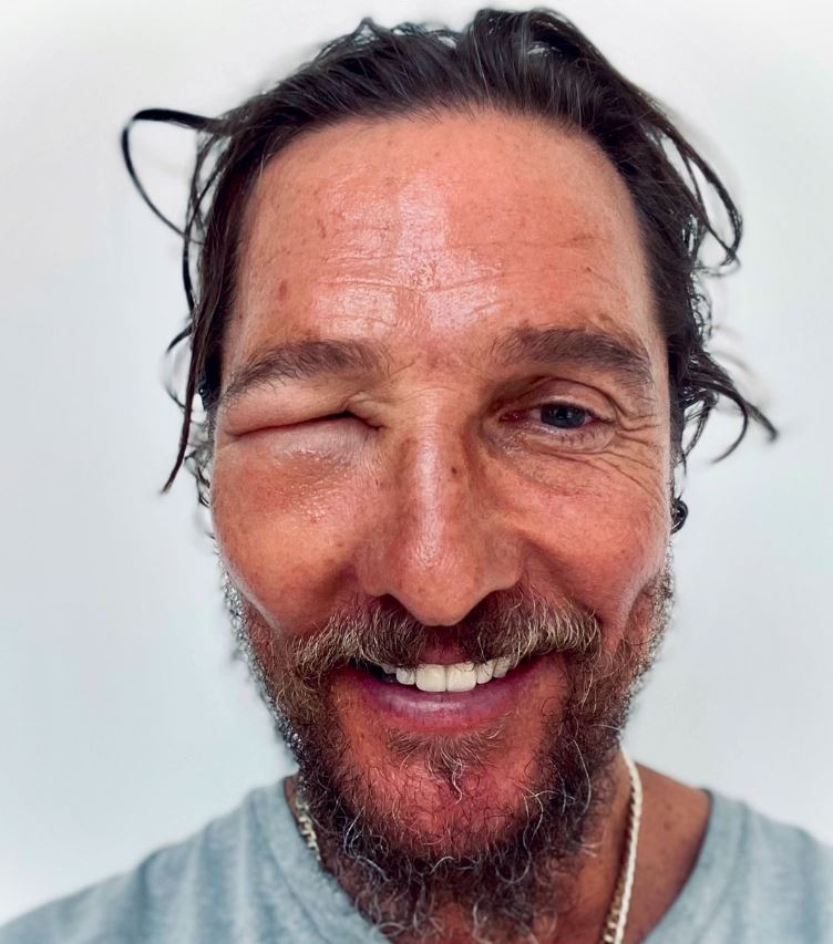 Matthew McConaughey și-a îngrijorat fanii după ce a apărut cu ochiul umflat. Ce a pățit actorul
