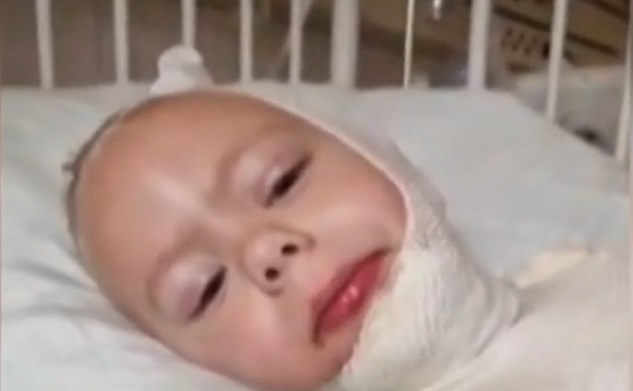 Szörnyű baleset: forró olajba esett egy 4 éves kisfiú Zombán, a ruhája szinte teljesen a bőrébe égett - videó