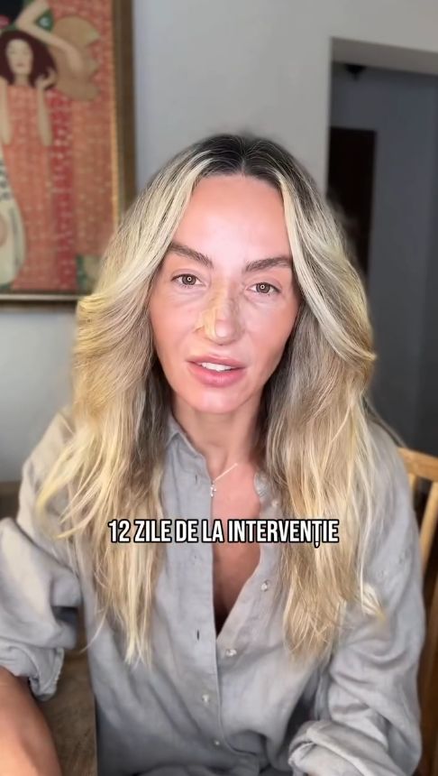 Reacția Flaviei Mihășan când și-a văzut nasul la 12 zile de la intervenție