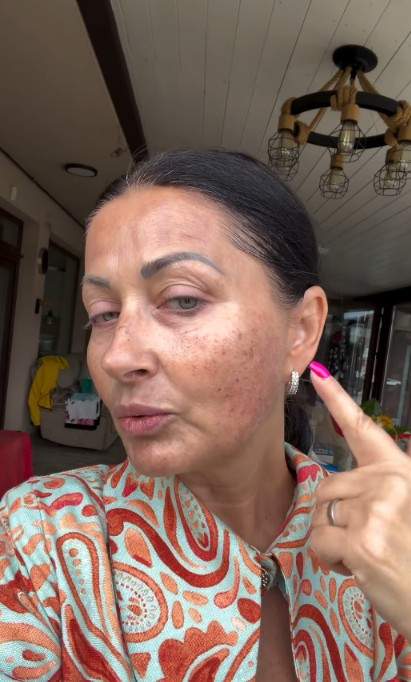 Gabriela Cristea și-a făcut terapie cu laser la față. Ce problemă a vrut să rezolve după cele două sarcini