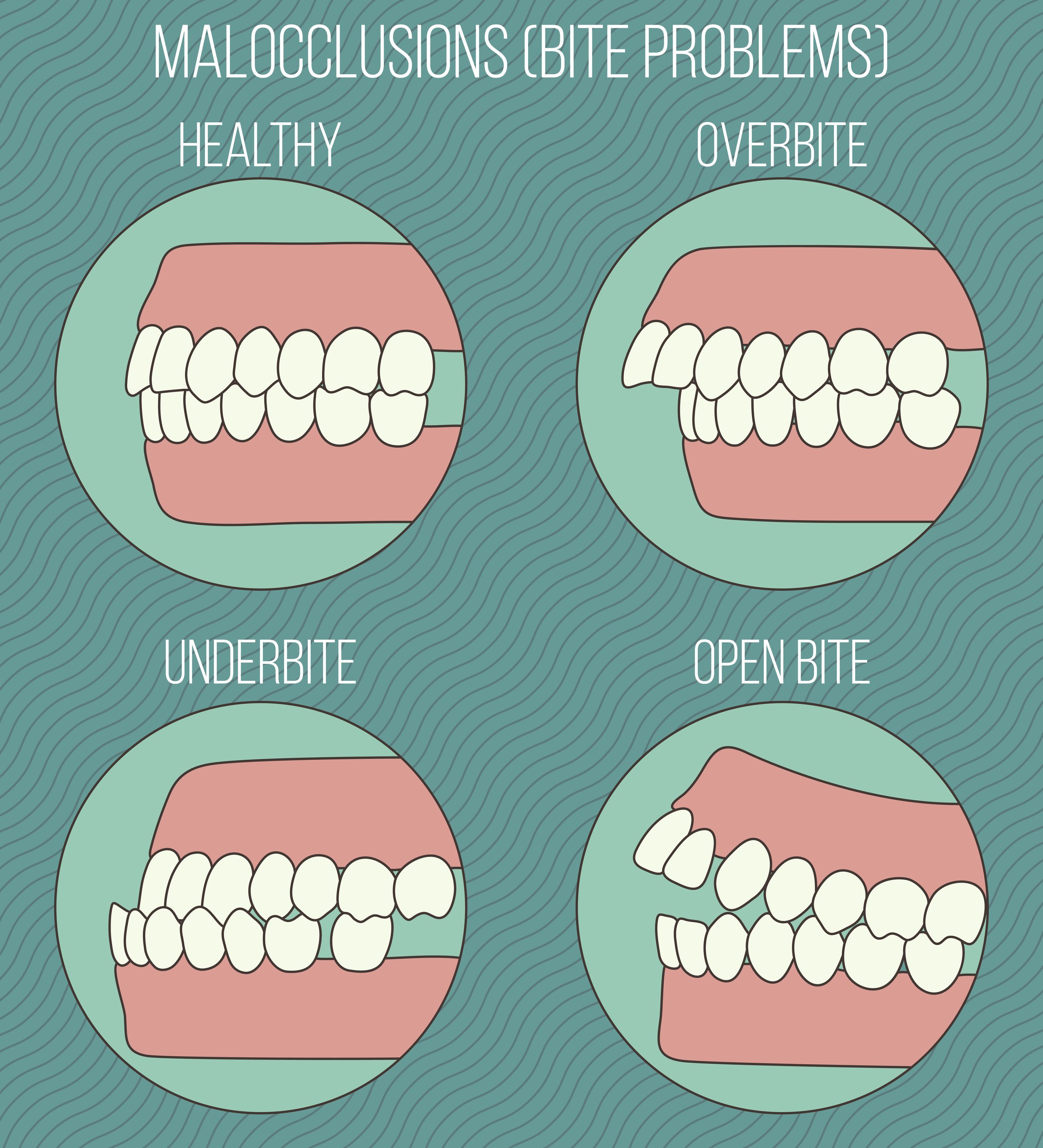 This condition is known as malocclusion [WoodSpringsDentist]