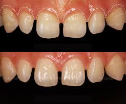 Gaps between teeth [MinishDentalHospital]