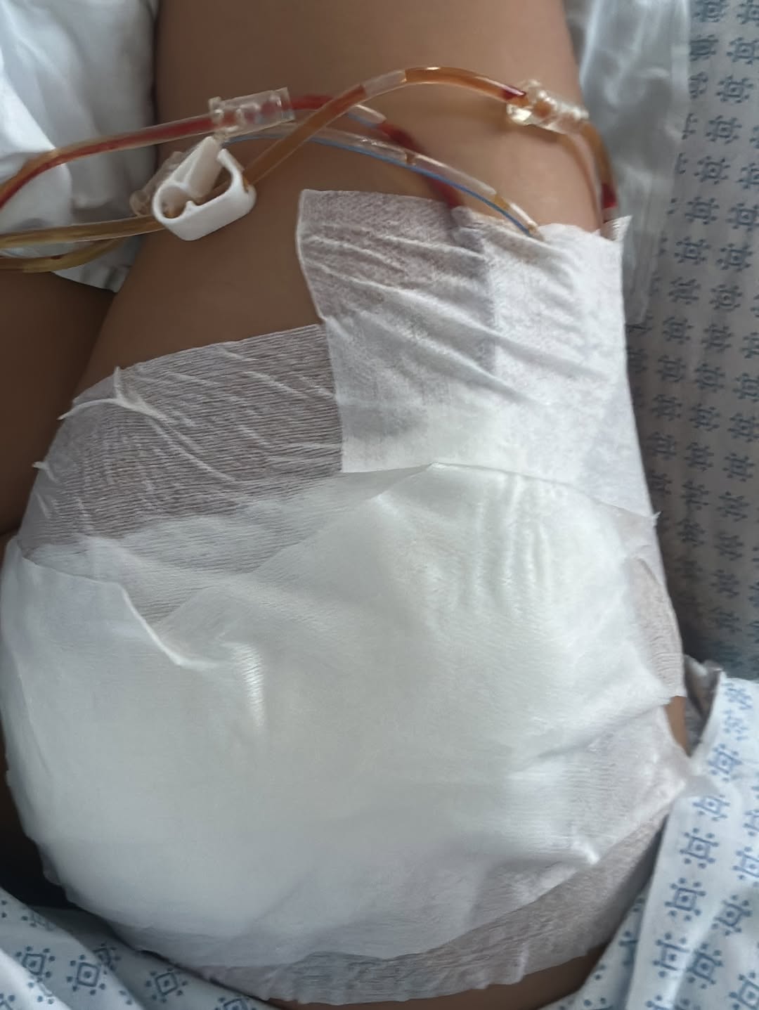 Antonia, de urgență la spital din cauza unei intervenții estetice: „Mi-am injectat Aquafilling ca să am un fund mai bombat”. A fost operată de trei ori și a fost la un pas de tragedie